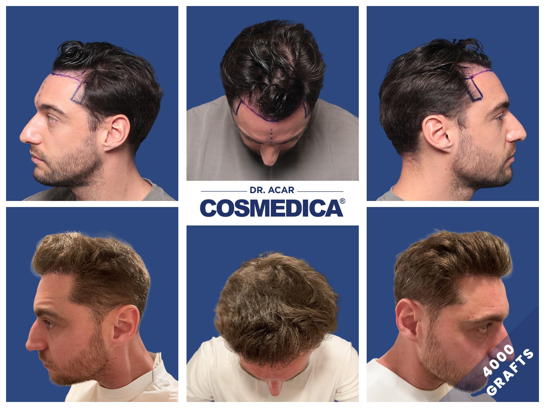Haartransplantation in der Türkei - Kosten Haartransplantation in der Türkei - Kosten